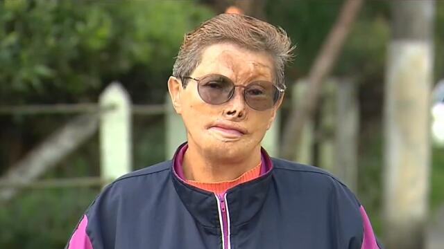 Mujer que se quemó con pólvora cuando era niña hace un llamado a todos los colombianos Mujer que se quemó con pólvora cuando era niña hace un llamado a todos los colombianos