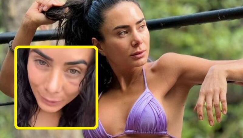 Johanna Fadul rompe el silencio sobre lesiones en su cara; dicen que le dieron en la jeta - LaKalle