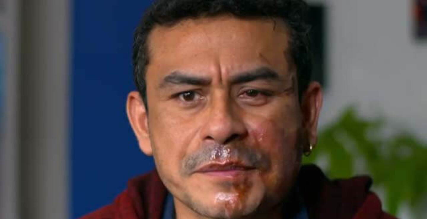 peruano_ataque_acido.jpg