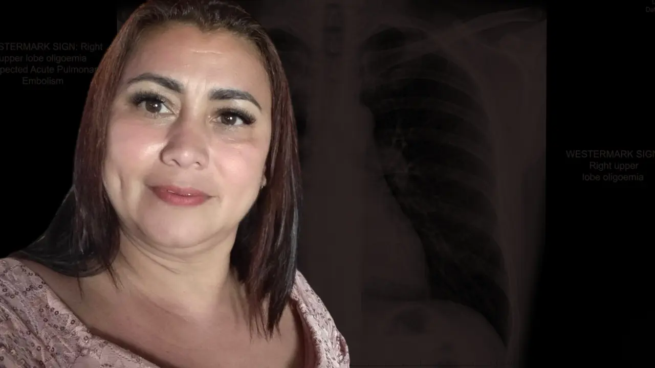 Yulixa Toloza murió por embolia pulmonar, según Medicina Legal