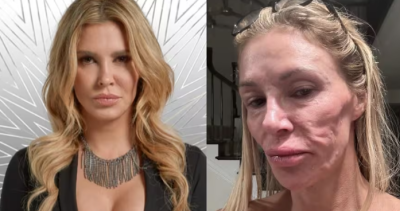Brandi Glanville explica qué le pasó en la cara tras implantes