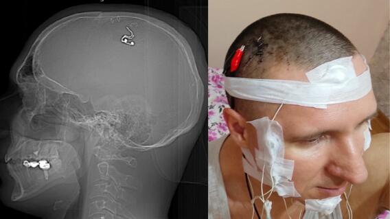 Cirugia cerebro Cirugia cerebro