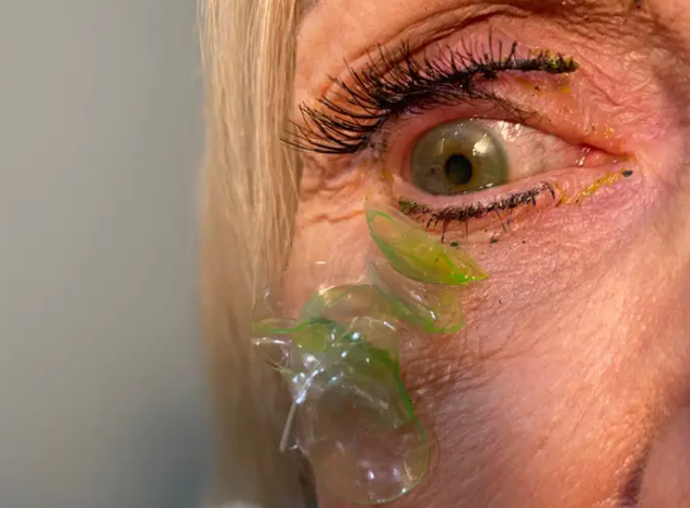 Mujer con 23 lentes de contacto en el ojo Mujer con 23 lentes de contacto en el ojo