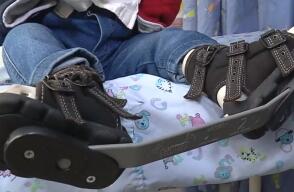 ¿Qué es el pie equino varo y cuál es su tratamiento?