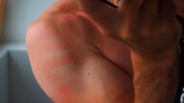 ¡Ojo! Baños de hierbas, comunes para fin de año, pueden causar lesiones en su piel