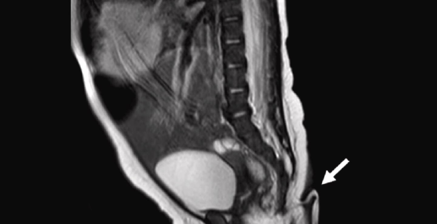 Radiografía de supuesta cola con la que nació una bebé 