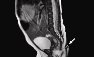Radiografía de supuesta cola con la que nació una bebé 