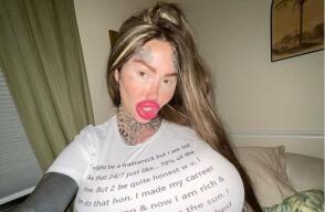 Mujer con implantes de 10kg