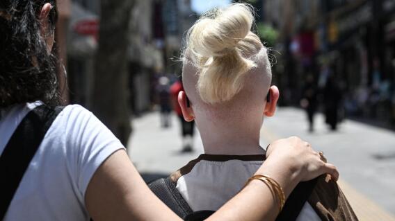 Albinos Albinos