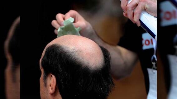 337549_BLU Radio // Calvicie // Foto: AFP