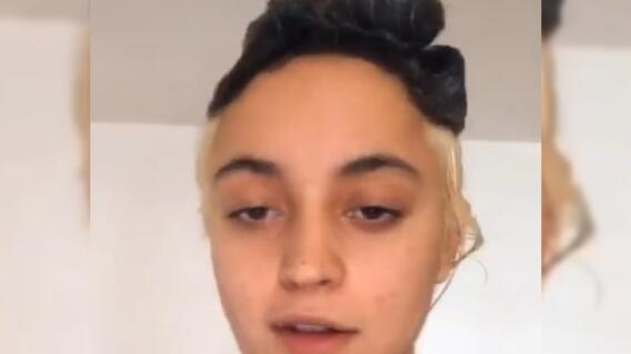 23287_Mujer se tinturo el cabello y terminó en el hospital // FOTO: Foto captura de video 23287_Mujer se tinturo el cabello y terminó en el hospital // FOTO: Foto captura de video