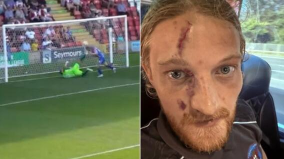 Futbolista sufrió dura patada en la cara en quinta división de Inglaterra.