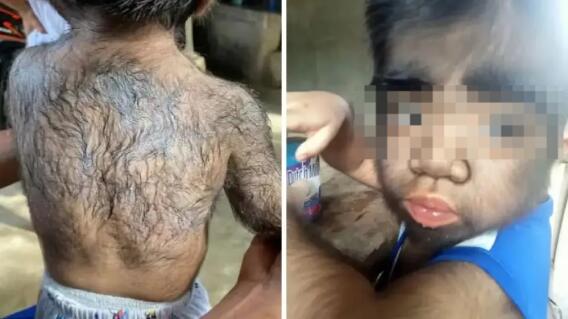 Niño más "peludo" del mundo Niño más "peludo" del mundo