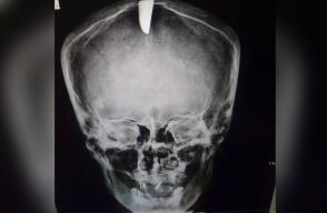 11831_Delincuentes incrustaron un cuchillo en la cabeza de un hombre.