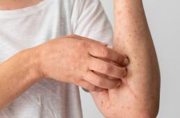 Alertan por aumento de casos de varicela en Colombia, según el INS: experta da recomendaciones