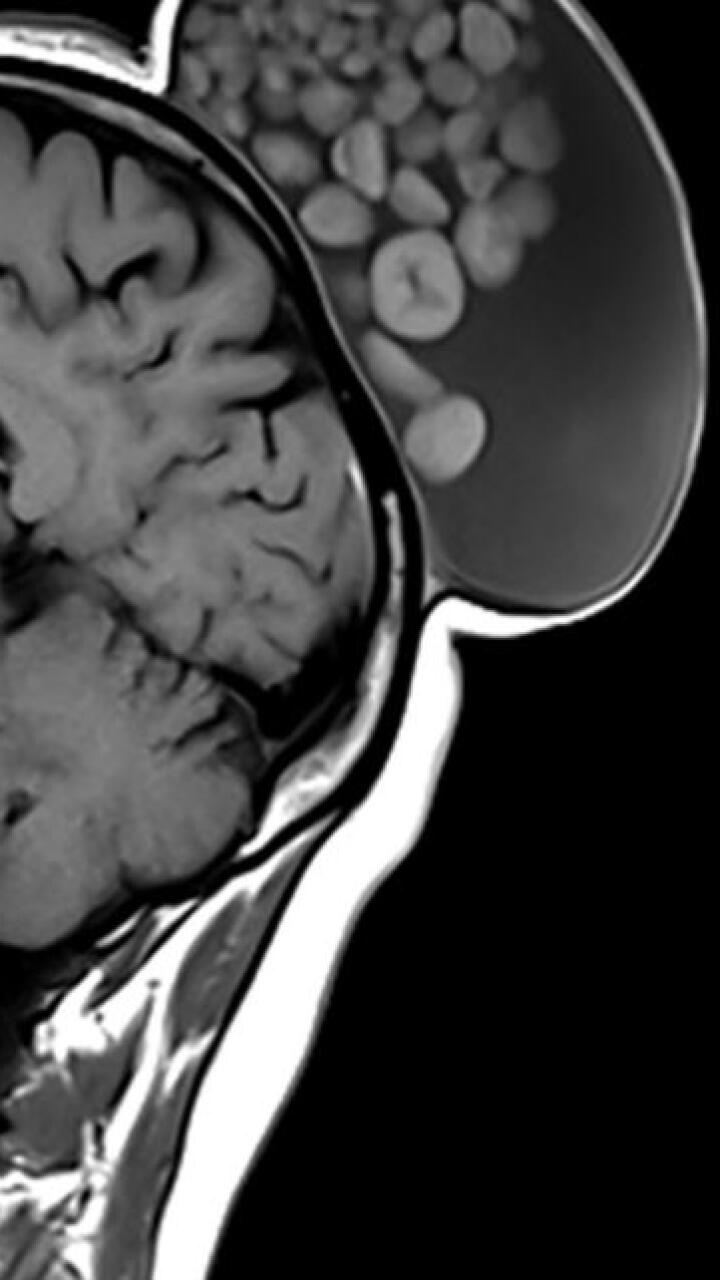 Médicos extirparon un “saco de canicas” que le creció a una mujer en el cuero cabelludo