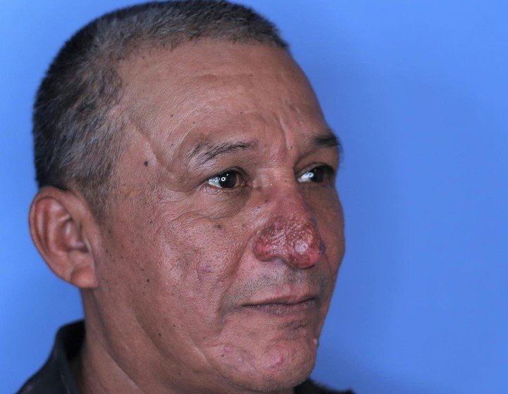 Reconstrucción de nariz