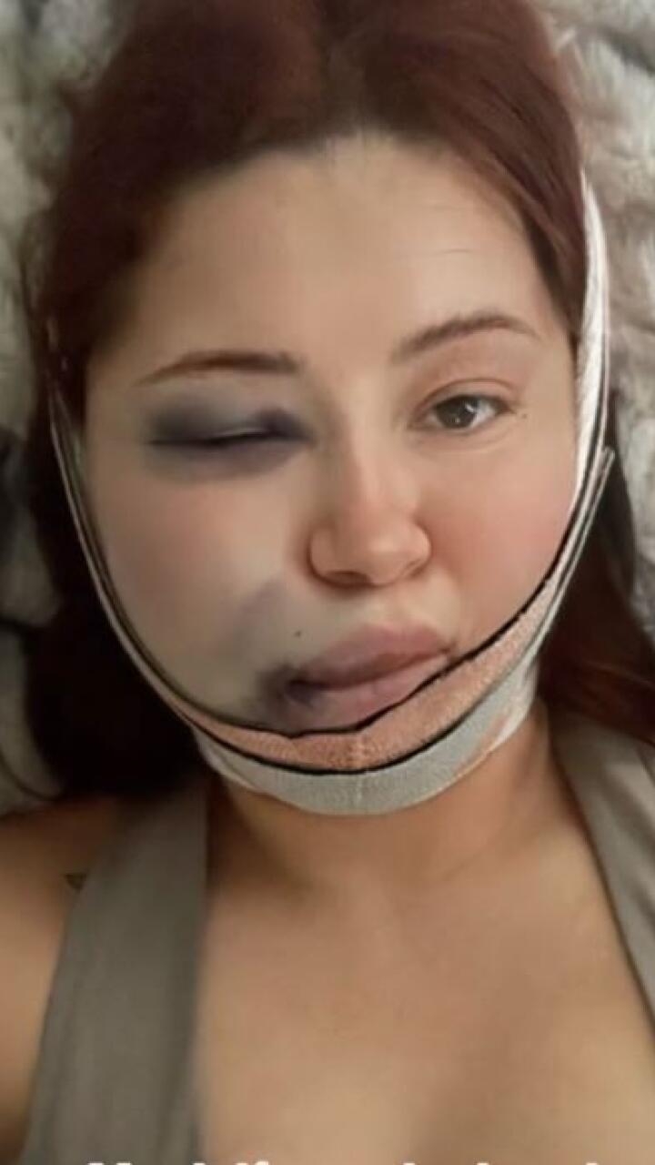 Joven relata la pesadilla que vivió tras hacerse una bichectomía: “Sentía que el cachete se me iba a estallar”
