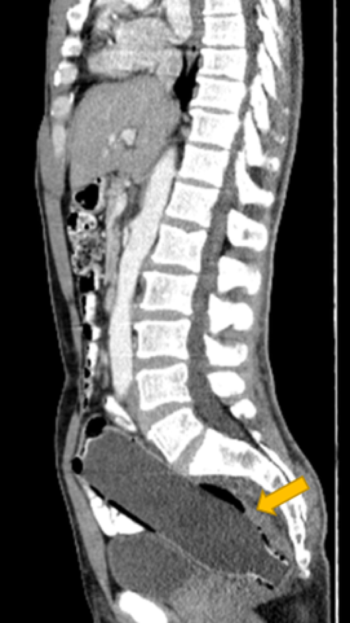 Hombre terminó en el hospital luego de tener durante tres días una botella atorada en el recto 